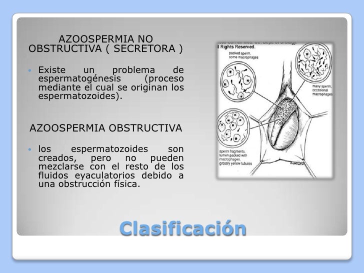 azoospermia no obstructiva